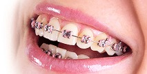 Zorgverzekering met vergoeding voor orthodontie